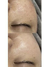 フットミー(foot mii)/肌質改善・毛穴ケア