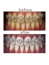 セルフホワイトニング専門店　 ホワイトニングショップ船橋2号店【ホワイトニング】/Before&After美白ホワイトニング