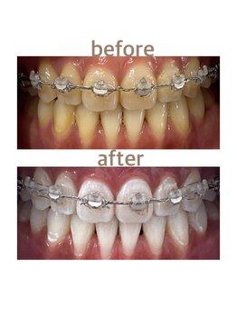 ホワイトニングショップ 船橋2号店/Before&After美白ホワイトニング