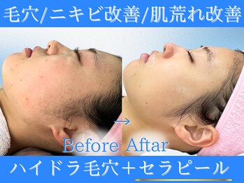 Cスキンケアクリニック 麻布店/ハイドラ毛穴+韓国セラピール