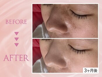 クリアラボ 池袋2nd(Clear Lab)/韓国肌管理&毛穴洗浄専門店