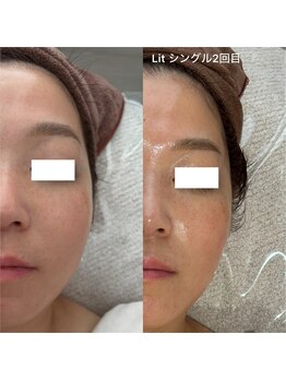 ラ トゥール(La tour)/臍帯・羊膜幹細胞エステ【Lit】