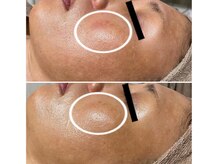 エステ リラクゼーションサロン(more)/SR光（フォト）フェイシャル