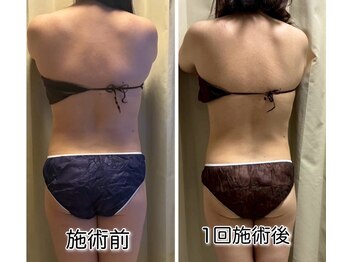 クールスパ(COOL SPA)/30代女性 &nbsp;背中症例