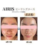 アイリス(AIRIS)/フェイシャル/毛穴ケア/美白