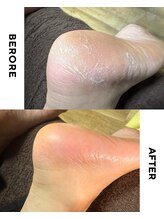 ゼロ(ZERO)/角質フットケア☆before&after