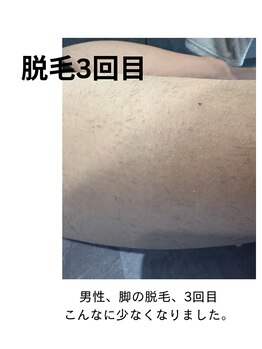 キト(KITO)/メンズ脱毛