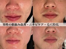 ハーブピーリング 名古屋の雰囲気(男性も大歓迎☆ 結果のでる肌質改善はハーブピーリング名古屋♪)