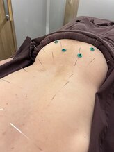 ハリマジック 代官山(HARI MAGIC)/【代官山/鍼灸/美容鍼】