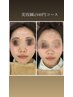【電気美容鍼＋フェイシャルマッサージ】リフトアップ効果で理想の美小顔に♪