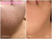 テン(10ten)/ニキビ・ごわつき改善