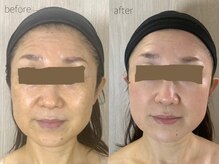 バービーフェイス 恵比寿(Barbie Face)/グリーンピールソフト1Day1g 2回