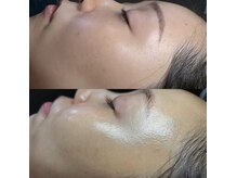 オンフリーク(ON FLEEK)の雰囲気（剥離しない肌育ラミネーションピール★直後から効果実感！！）