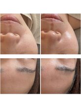 プリュムアイ フェイシャルホーム(prume eye.facial home)/肌改善
