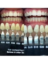 トウキョースワーズ 渋谷店(TOKYO SWRS)/#ホワイトニング #渋谷 #池袋