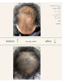 スカルプラボ 倉敷店(Scalp Lab)/moumitu9ヶ月症例