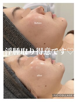 リモナ(Re-mona..)/REVIハーブピーリング