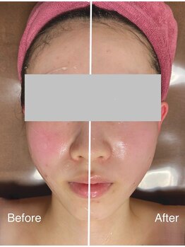 ハナ トータル ケア(Hana Total Care)/ベビースキン水玉リフティング