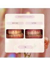 プラスビー 2号店(+b)/ホワイトニングビフォーアフター