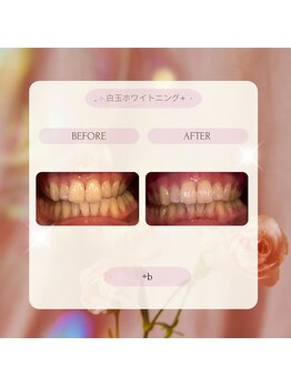 プラスビー 2号店(+b)/ホワイトニングビフォーアフター