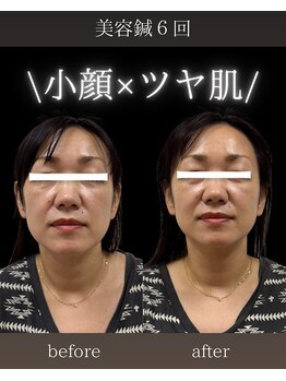 治楽院よう/美容鍼/電気美容鍼