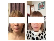 サロン ド ルポゼ(Salon de Reposer)の雰囲気（お顔の悩みのタルミ、ほうれい線にアプローチ！）