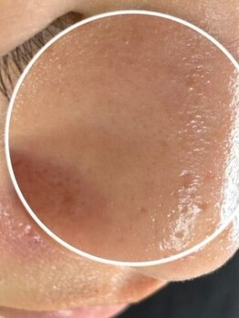 オーガスター(ORGASTAR)の写真/【4月限定☆毛穴リセット】頑固な角栓・皮脂汚れを徹底洗浄！美容成分でキュッと引き締め、滑らか素肌へ☆