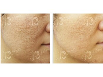 ハーバリー ハーブピーリング 岐阜(HERBERRYハーブピーリング)/ハーブピーリング専門店HERBERRY