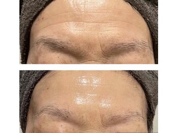 アドビューティ(Add Beauty)/≪プラズマフェイシャル≫