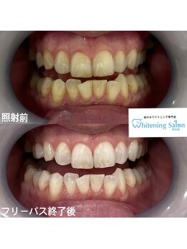 ホワイトニングサロン 熊本店/誰でもホワイトニング
