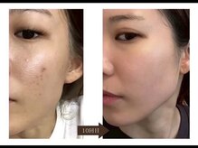 ダブリュービー(WB)/ハードハーブピーリング10回目