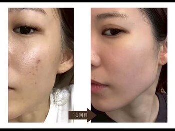 ダブリュービー(WB)/ハードハーブピーリング10回目