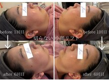 ユフラ(Juhla)の雰囲気（茨城近隣希少！切らない小顔リフト1度でリフトアップサーマル）