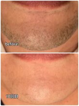 メンズガーデン(men's Garden)/ヒゲ脱毛で剃刀から解放