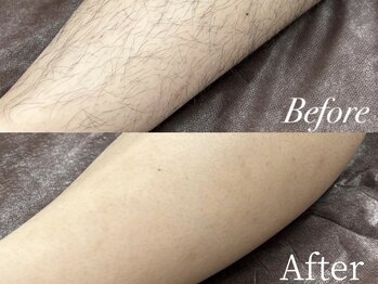 ボス 鈴鹿店(BOSS)/before after　#脱毛＃全身脱毛