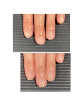 ウェルズユキ(well's yuki)/自爪育成ビフォーアフター