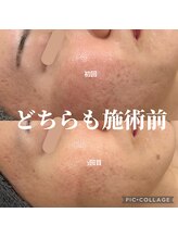 リモナ(Re-mona..)/REVIハーブピーリング