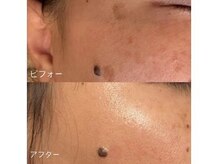 ラエッセ 目黒 白金台店(LAESSE)/毛穴・美白専門店 LAESSE 白金台