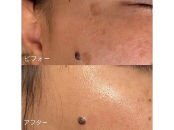 ラエッセ 目黒 白金台店(LAESSE)/毛穴・美白専門店 LAESSE 白金台