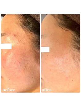 美温(mion)/ショートカットピーリング