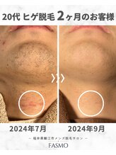ファスモ(FASMO)/20代 / ヒゲ脱毛 / 2ヶ月目