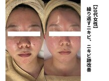 ボニータ(Bonita)/【Lit】ヒト羊膜幹細胞エステ