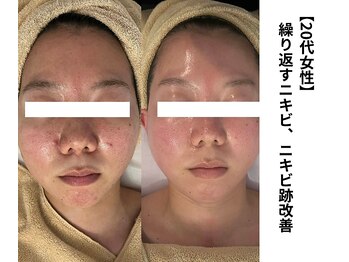 ボニータ(Bonita)/【Lit】ヒト羊膜幹細胞エステ