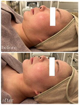 メゾンリュバン 梅田店(Maison Ruban)/エステ版オンダリフトプロ