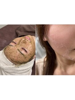 Epurer（エステ）の写真/毛穴の黒ずみ・開きを解消！ごっそり洗浄＆ひんやりパックで引き締まったなめらかつるすべ肌へ導く♪