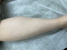 ナノハナ/鹿沼市の全身脱毛のナノハナ