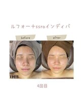 インディバケアプラチナム 横浜店/インディバ施術
