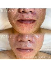 ルチル 八女店(Rutile)/赤み、痒み、ひりつき