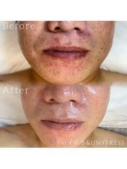 ルチル 八女店(Rutile)/赤み、痒み、ひりつき