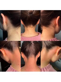 シュシュ 梅田店(+Chou chou)/うなじ脱毛